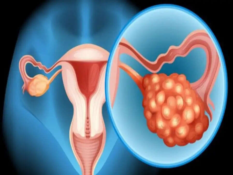 Health Tips-&nbsp;ओवेरियन कैंसर होने पर दिखाई देते हैं ये लक्षण, जानिए इनके बारे में