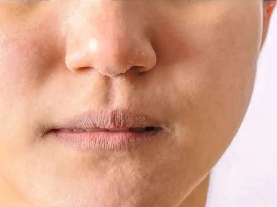Skin Care Tips-&nbsp;हल्की सर्दियों में स्किन हो जाती हैं रूखी और फटी हुई, ऐसे रखें इसका ख्याल