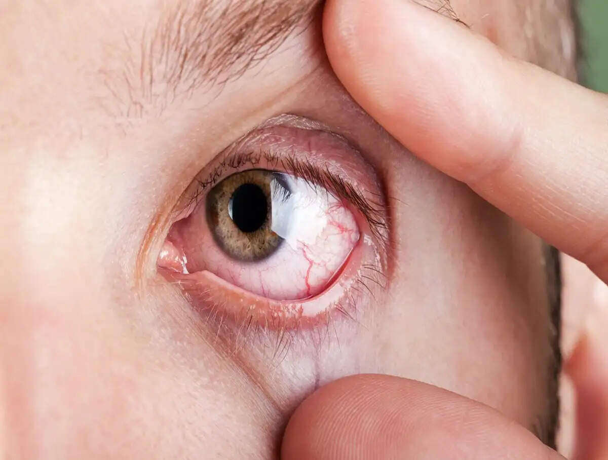 Eye Care Tips- क्या केवल स्क्रीन टाइम से ही आंखों का सूखापन होता हैं, आइए जानते हैं विशेषज्ञों की राय