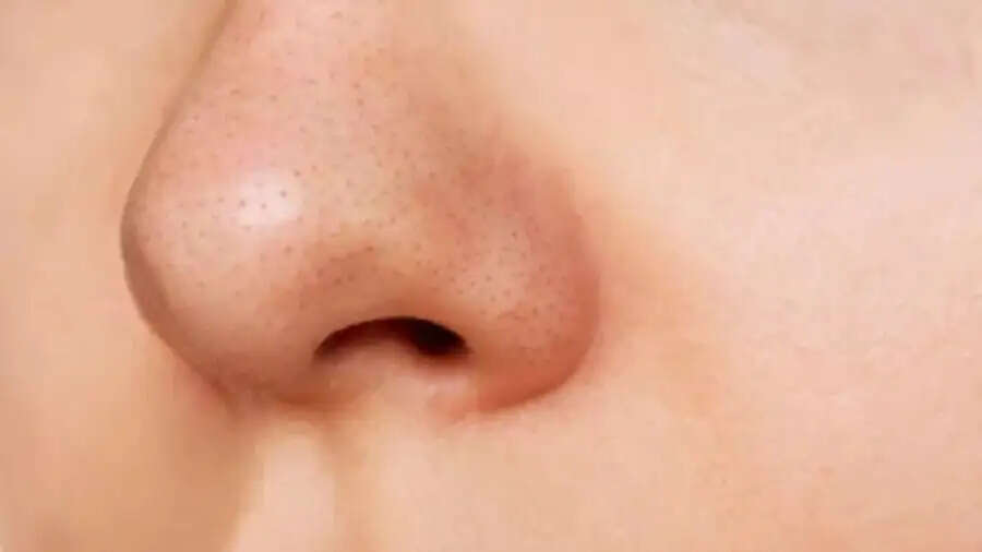 Blackheads Tips-&nbsp;क्या आप ब्लैकहेड्स से परेशान हैं, राहत पाने के लिए अपनाएं ये हैक्स