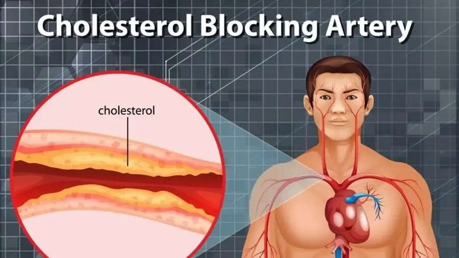 Health Tips- बढ़ता हुआ बैड कोलस्ट्रॉल बन रहा हैं स्वास्थ्य के लिए जोखिम, ऐसे करें कंट्रोल
