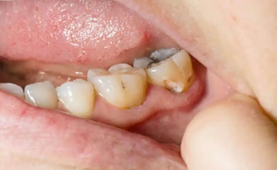 Teeth Care Tips-&nbsp;दांत के दर्द से राहत पाने के लिए अपनाएं ये घरेलू उपाय, जानिए इनके बारे में