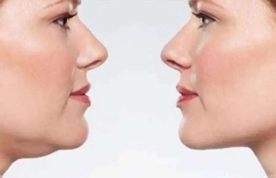 Neck Fat Tips-&nbsp;गर्दन पर बढी चर्बी ने कर दी हैं खूबसूरती, तो शुरु करें ये एक्सरसाइज