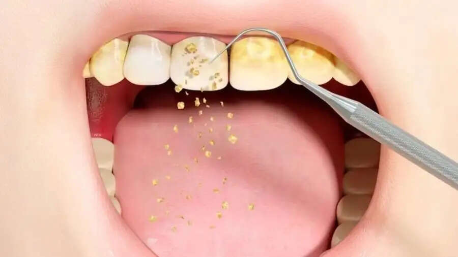 Teeth Care Tips-&nbsp;क्या पीलें दांत बन रहे हैं शर्मिंदिगी का कारण, जानिए इनको साफ करने का तरीका