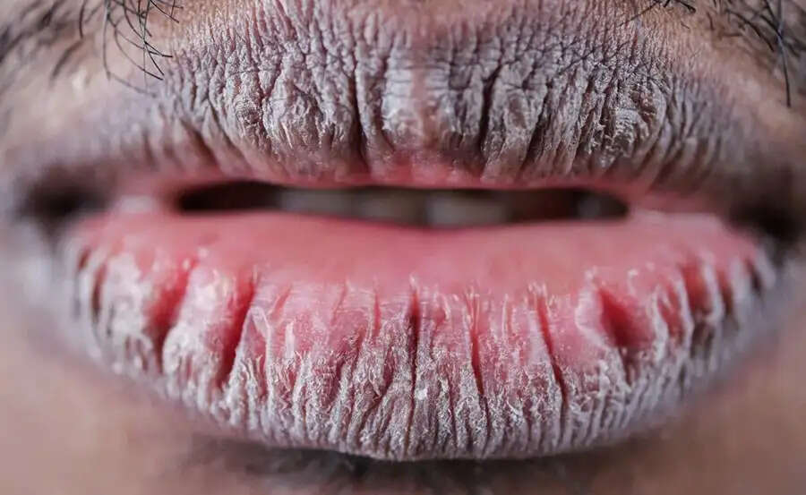 Lips Care Tips-&nbsp;क्या होठों के कालेपन ने कर दिया हैं परेशान, जानिए इसके घरेलू उपाय