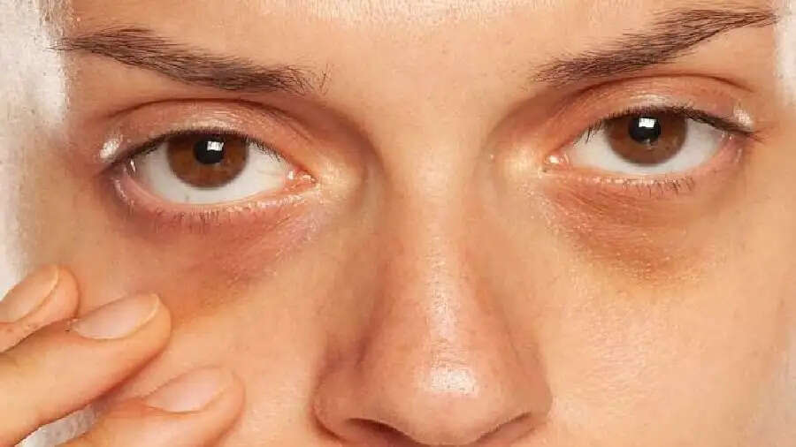 Dark Circles-&nbsp;आंखों के नीचे पड़े काले घेरों को ऐसे करें कम, आइए जानें इनका घरेलू उपाय