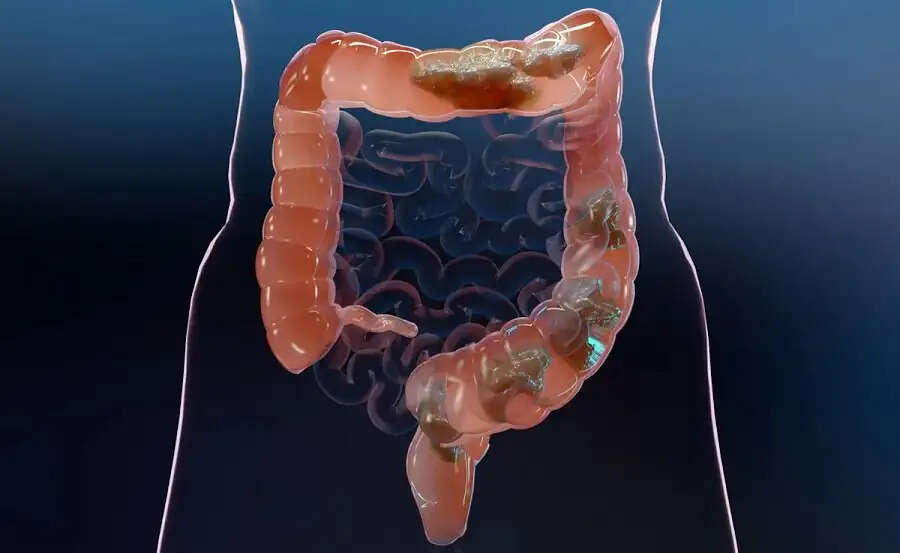 Health Tips-&nbsp;आंतों में जम गई हैं गंदगी, तो ऐसे करें इनकी सुरक्षा