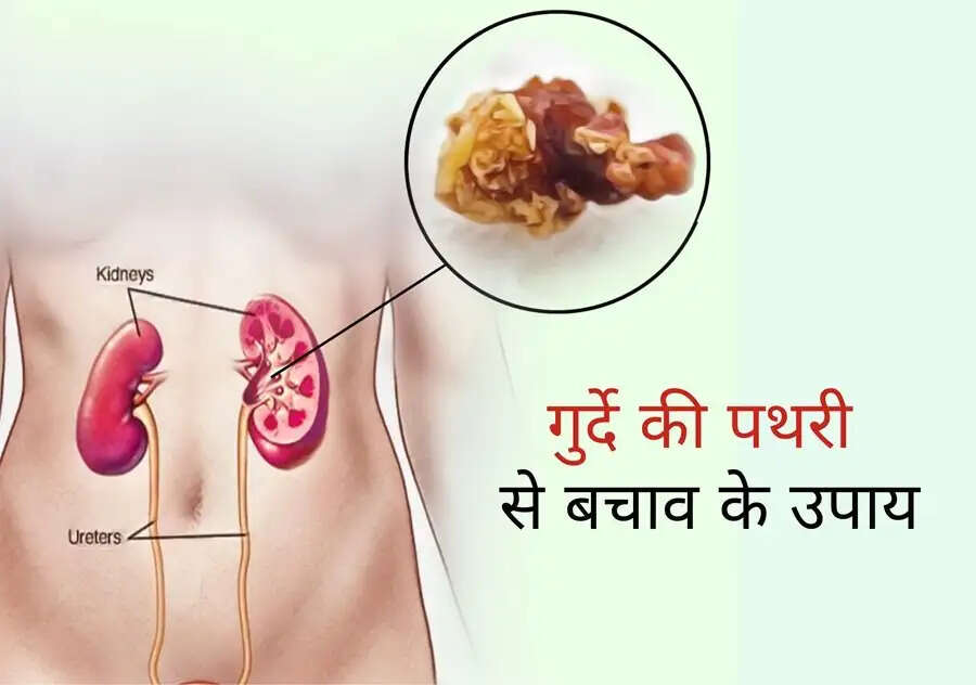 Health Tips – किडनी में स्टोन होने से बचाने के लिए अपनाएं ये तरीके, जानिए इनके बारे में