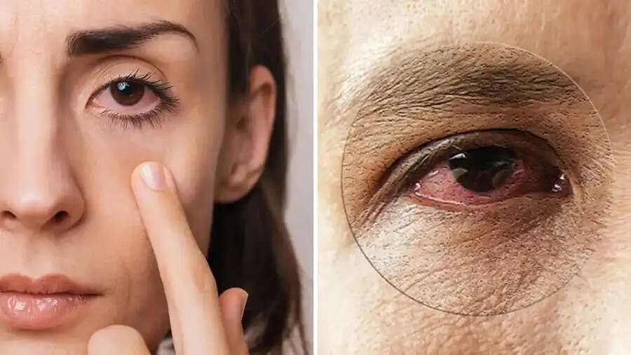 Eye Care Tips- क्या आपकी आंखों से पानी बहता है, तो इन चीजों का करें सेवन