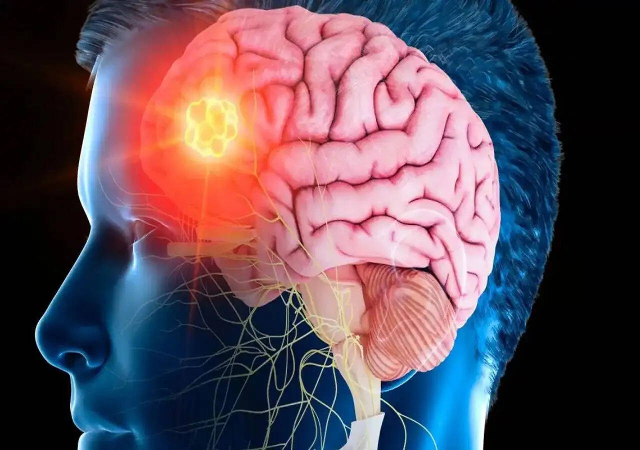 Health Tips- ब्रेन स्ट्रोक होने पर शरीर में दिखाई देते हैं ये लक्षण, जानिए इनके बारे में