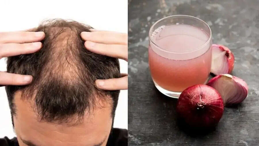Hair Care Tips- क्या सच में प्याज का रस लगाने से सिर में नए बाल आते हैं, आइए जानें पूरी डिटेल्स