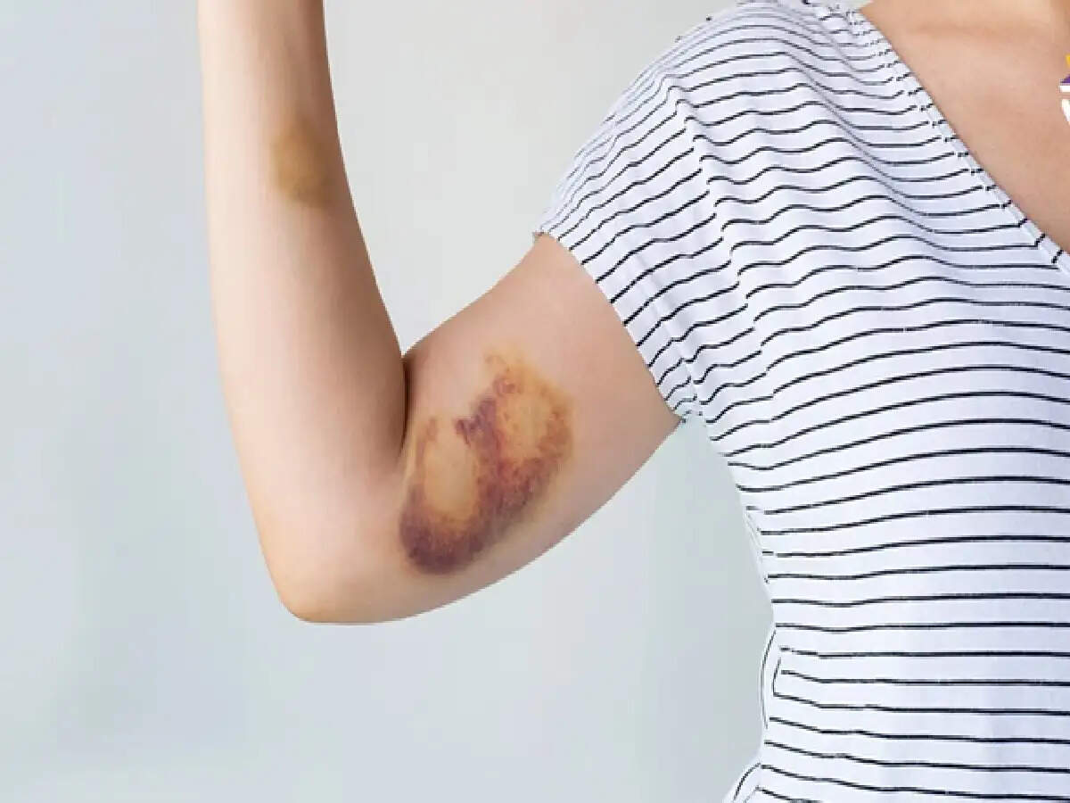 Blue bruises on skin: क्या बिना किसी चोट के भी शरीर पर नीले धब्बे दिखते हैं? हो सकते हैं इन बिमारियों के संकेत