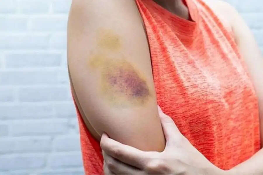 Blue Dots on Body- क्या शरीर पर दिखाई देने लगे नीले निशान, तो इस विटामिन की हो गई हैं कमी