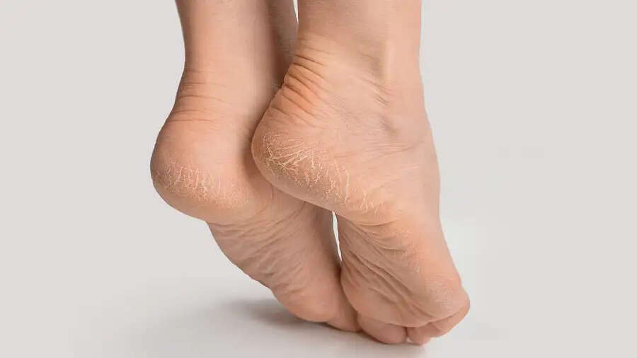 Crack Heels-  क्या फटी एड़ियों ने कर रखा हैं परेशान, छुटकारा पाने के लिए अपनाएं ये टिप्स