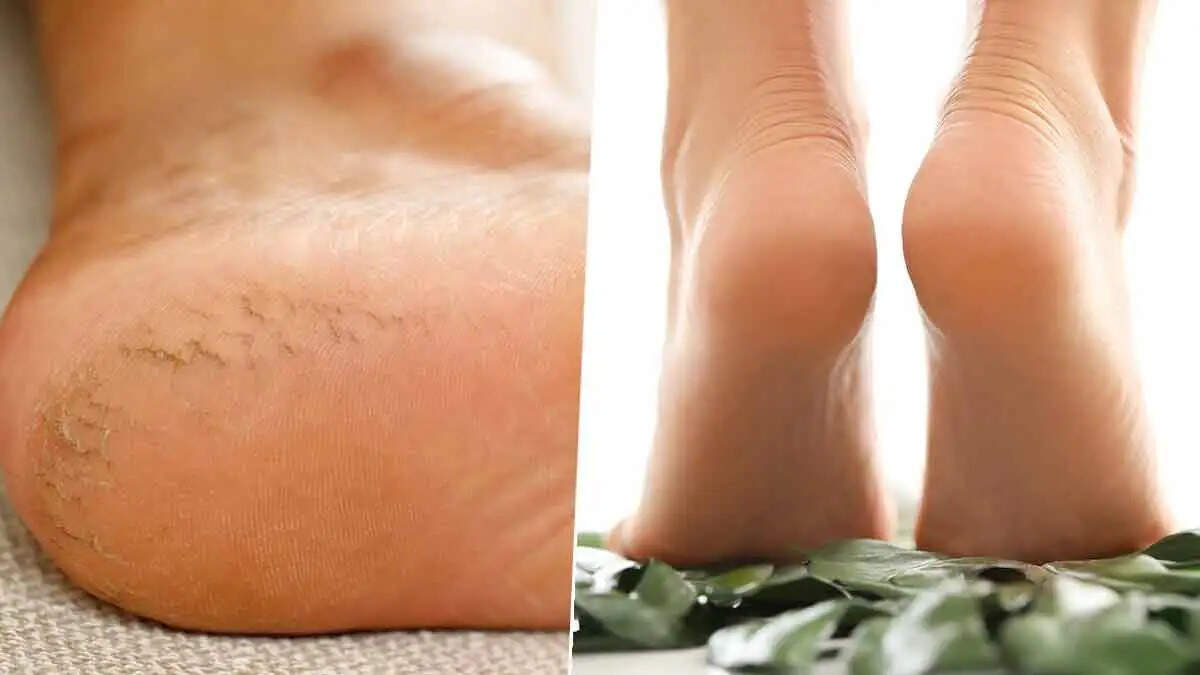 Health Tips- मौसम में परिवर्तन के कारण फट गई हैं एड़ियां, जानिए इसके उपाय