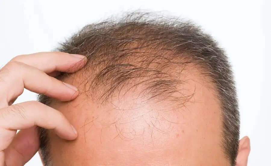 Hair Care Tips-&nbsp;क्या कम उम्र में ही गंजापन कर रहा हैं परेशान, राहत पाने के लिए बालों में लगाए ये तेल