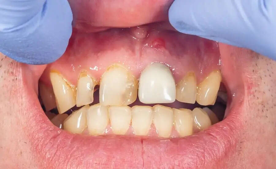 Teeth Care Tips-&nbsp;क्या दांतों की कैविटी ने कर रखा हैं परेशान, छुटकारा पाने के लिए अपनाएं ये आदतें