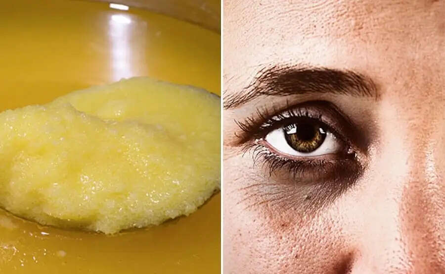 Dark Circles Treatment-&nbsp;क्या आंखों के नीचे पड़े डार्क सर्कल ने खूबसूरती कर दी हैं खराब, जानिए हटाने का बेस्ट तरीका