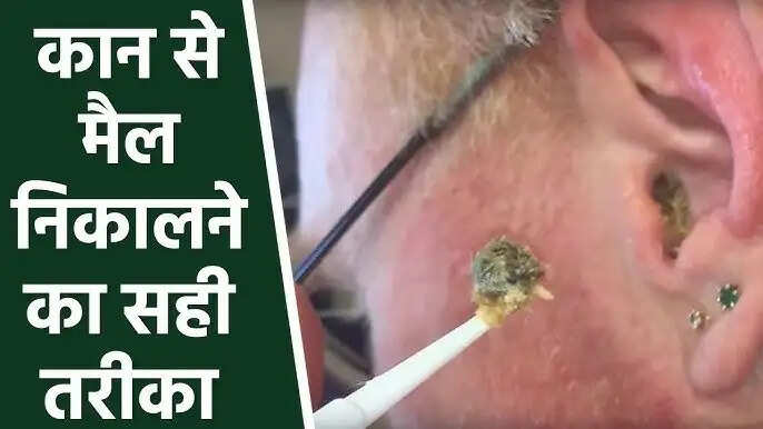 Ear Care Tips- कान का मैल साफ करने का सबसे आसान तरीका जान लिजिए, तुरंत होगी गन्दगी साफ