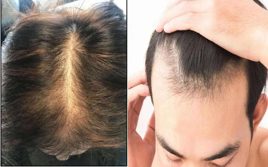 Hair Care Tips- न्यूट्रिशन जिनकी वजह से बाल झड़ते हैं, आइए जानते हैं इनके बारे में
