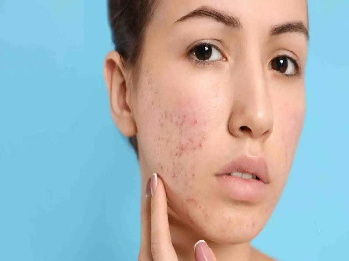 Skin Care Tips- क्या आपको बार बार मुंहासे होते हैं, आइए जानते हैं ये किस बीमारी के संकेत है