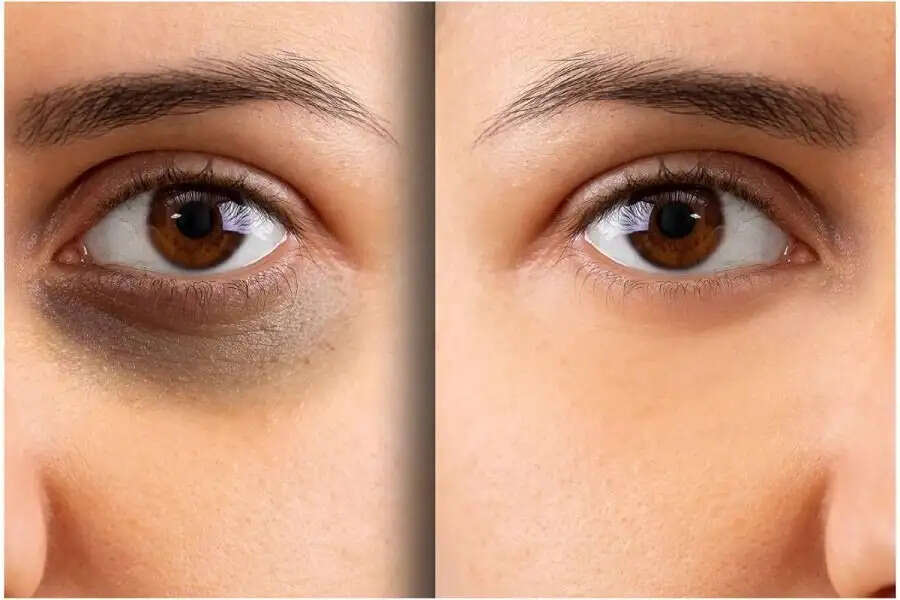 Skin Care Tips- क्या डार्क सर्कल ने कर रखा हैं परेशान, जानिए इसका कारण