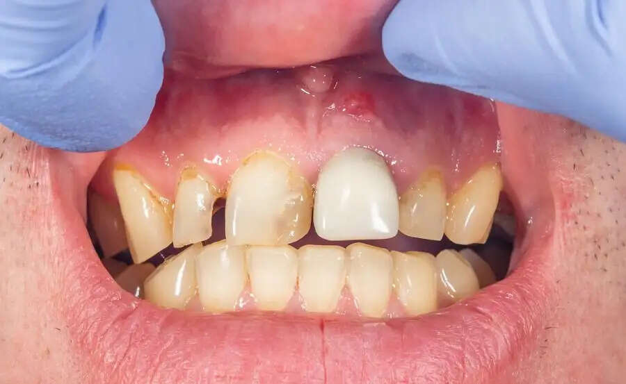 Teeth Care Tips-&nbsp;इन चीजों का भूलकर ना करें सेवन, दांत करते हैं खराब