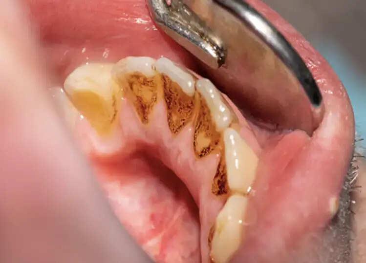 Dental Health: दांतों पर जम गया है प्लाक तो हटाने के लिए आजमाएं ये घरेलू नुस्खे, मोती से चमकने लगेंगे दांत