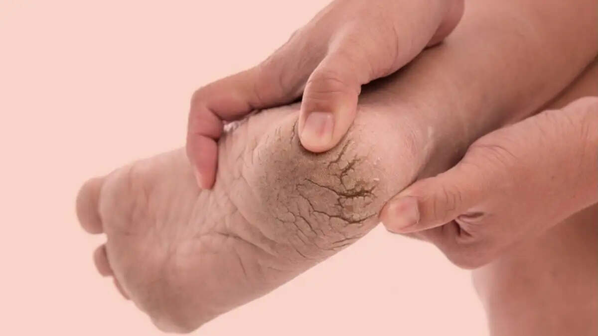 Health Tips- क्या सर्दी के कारण आपकी एड़ियां फट गई है, तो अपनाएं ये तरीके