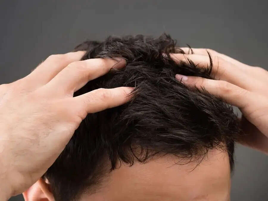 Hair Care Tips-&nbsp;इन वजहों से आप हो जाते हैं गंजेपन का शिकार, जानिए पूरी डिटेल्स