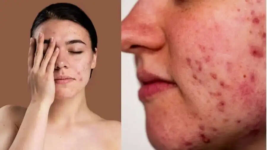Pimple Tips-&nbsp;आपकी इन गलतियों की वजह से होते हैं पिंपल, जानिए इनके बारे में