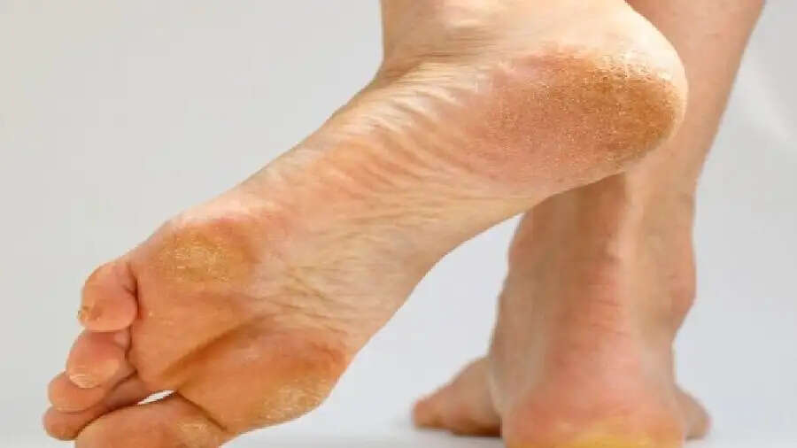 Skin Care Tips- क्या बारिश की वजह से पैरों के तलवे हो गए हैं खराब, ऐसे रखें इनका ख्याल