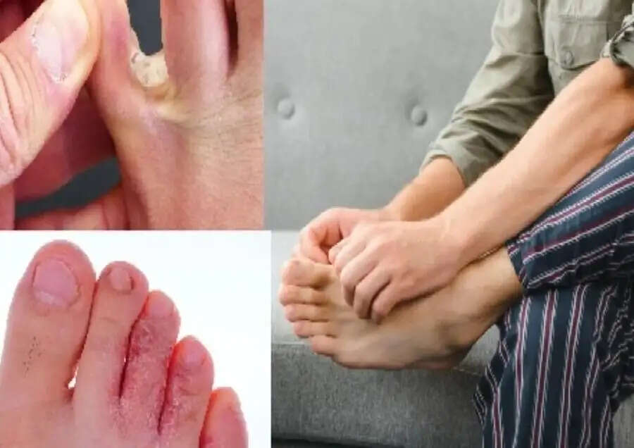 Health Tips-  क्या पसीनों की वजह से उंगलियों के बीच हो गई हैं फंग्स, जानिए कैसे करें बचाव
