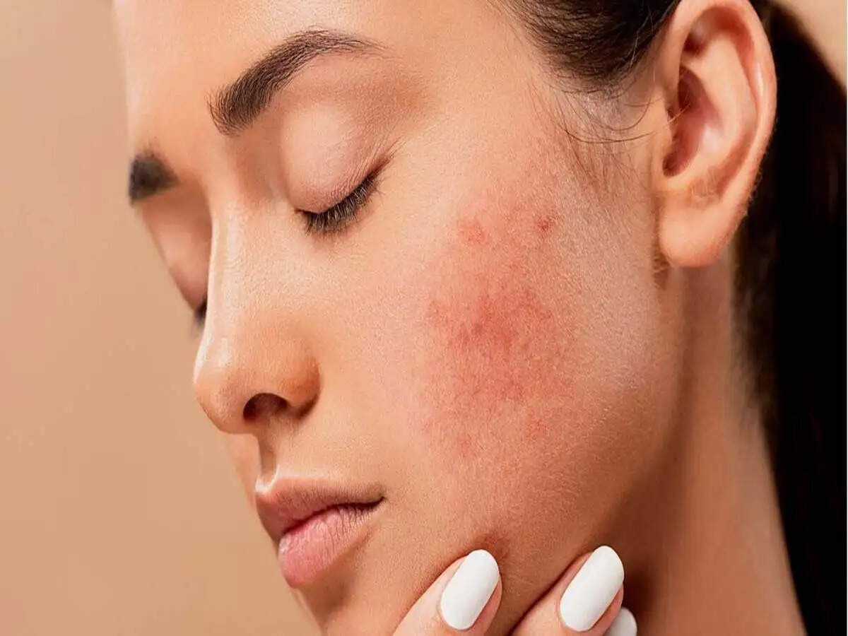 Skin Care Tips- वो खाने की चीजें जो चेहरे बढाती हैं एक्ने और पिंपल्स, आज ही बना ले इससे दूरी