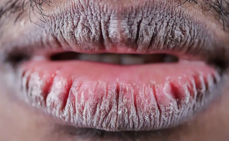 Lips Care Tips- क्या काले होठों की वजह से होना पड़ता हैं शर्मिंदा, गुलाबी होँठ के लिए अपनाएं ये उपाय