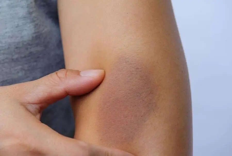 Black Marks Remove-&nbsp; क्या शरीर के काले धब्बों ने कर रखा हैं परेशान, हटाने के लिए अपनाएं ये टिप्स