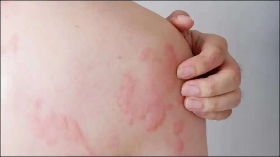 Skin Care Tips- इन बुरी आदतों की वजह से हो जाती हैं पित्ती, जानिए पूरी डिटेल्स