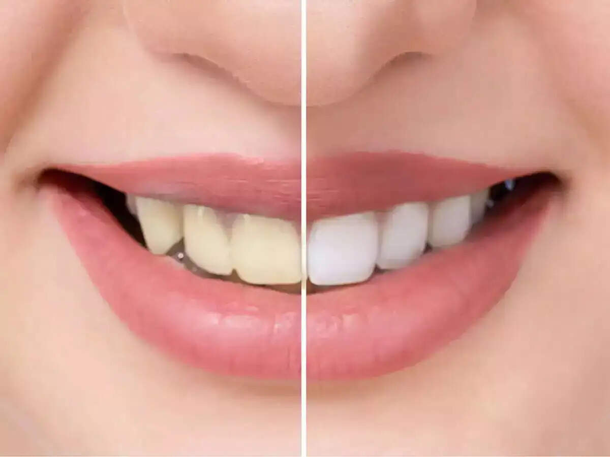 Teeth Care Tips- क्या आप पीले दांतों से परेशान हैं, दूध जैसे दांत पाने के लिए आजमाएं ये टिप्स