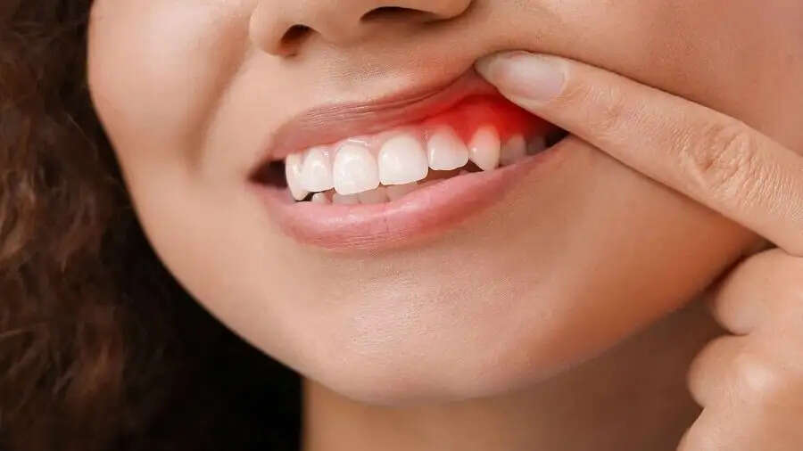 Teeth Care Tips- क्या पायरिया ने कर ऱखा हैं परेशान, तो ऐसे करें ठीक