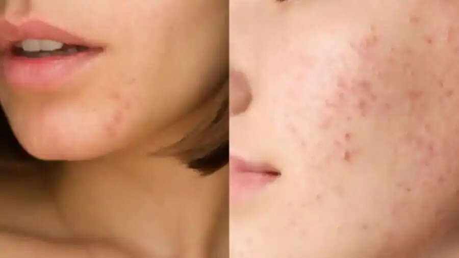 Pimples Tips-&nbsp;क्या आपको पता हैं चेहरे पर ही क्यों निकलते हैं पिंपल्स, चलिए जानते हैं