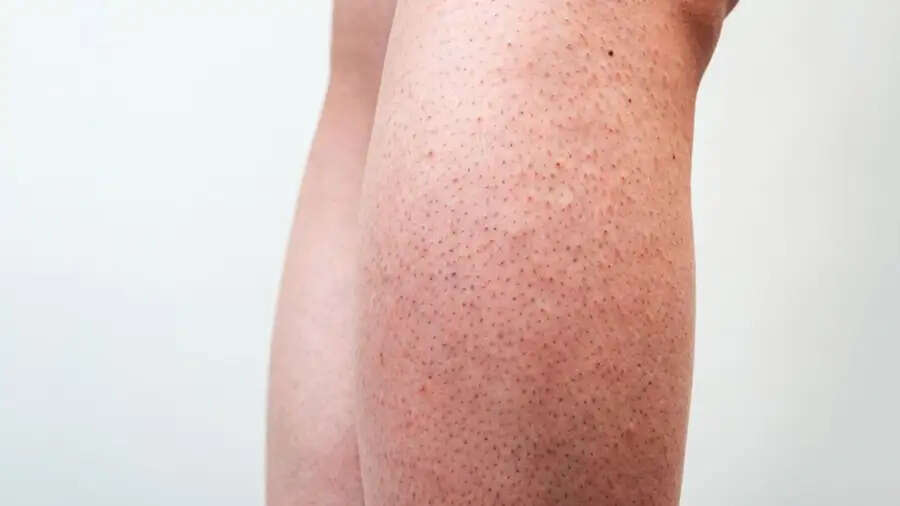 Health Tips- इन लोगो को जल्दी होता हैं&nbsp;स्ट्रॉबेरी लेग्स, जानिए इसकी वजह