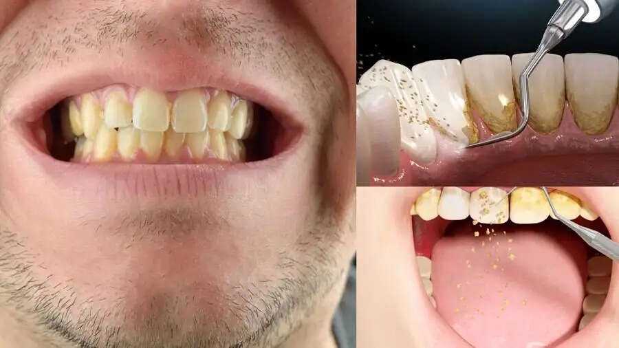 Teeth Care Tips- दांतों पर जम गया हैं प्लाक, दांत साफ करने के लिए अपनाएं ये टिप्स