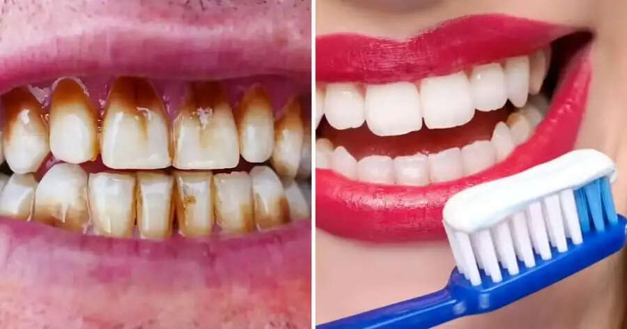 Teeth Care Tips- क्या आपको दांतों को दूध जैसा चमकाना हैं, तो करें ऑयल पुलिंग