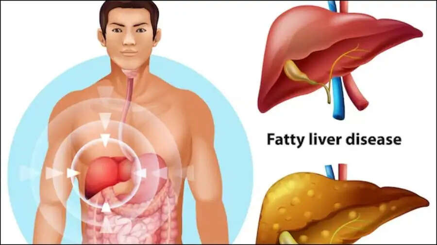 Health Tips-&nbsp;फैटी लिवर होने पर दिखाई देते हैं ये लक्षण, आइए जानें पूरी डिटेल्स