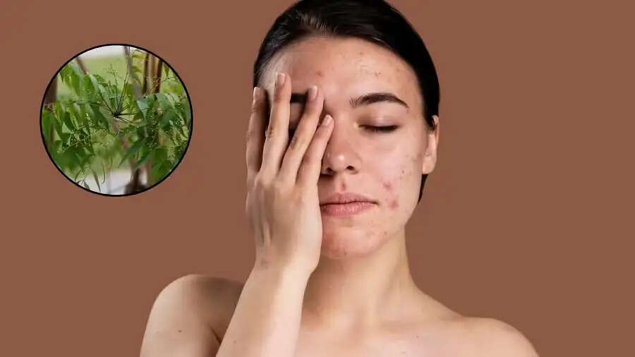 Skin Care Tips- क्या फोड़े फुंसी ने कर रखा हैं परेशान, तो लगाए ये 5 हरी पत्तियां