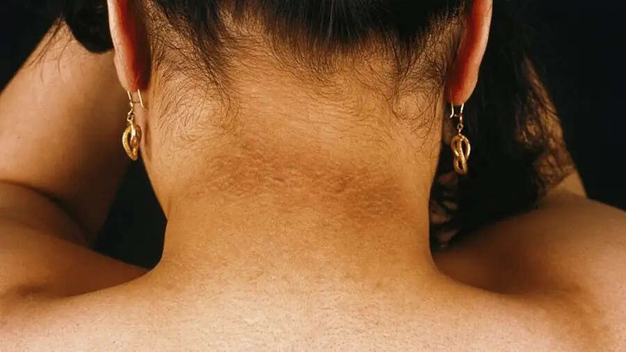 Black Neck Tips-&nbsp;क्या काली गर्दन कर देती हैं शर्मिंदा, तो इन घरेलू उपायों से करें साफ