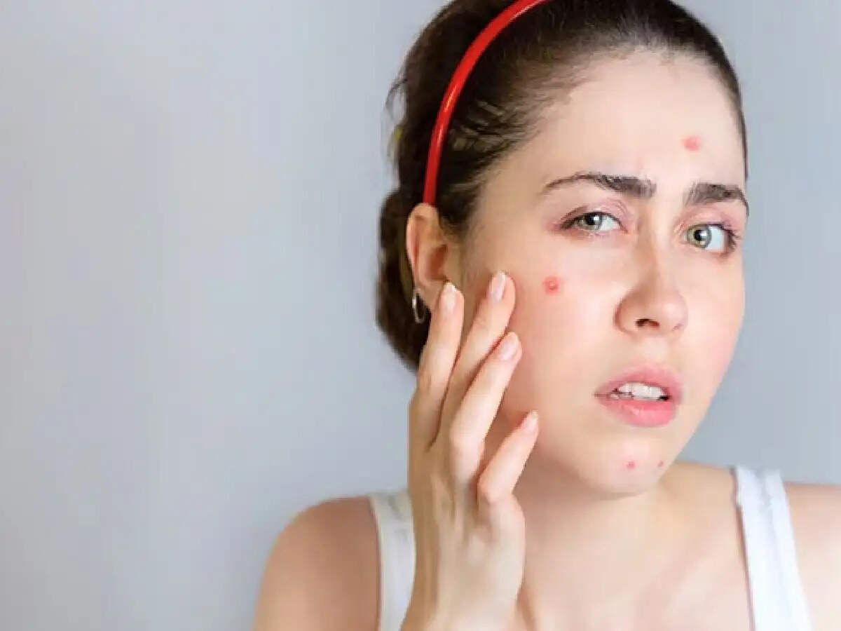 Period Acne: क्या आपको पीरियड्स से पहले चेहरे पर बार-बार पिंपल्स होते हैं? सावधान रहें, ये है 5 मुख्य कारण