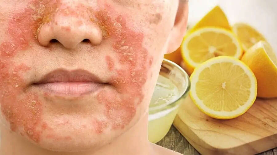 Skin Care Tips-&nbsp;चेहरे पर नींबू लगाने से हो सकता हैं नुकसान, जानिए पूरी डिटेल्स