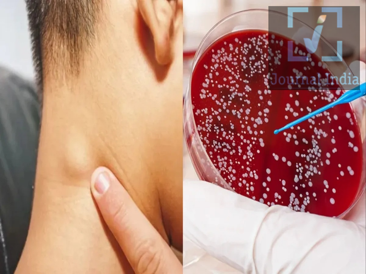 Health Tips- क्या रेगुलर CBC जांच हमें ब्लेड कैंसर से बचा सकती हैं, आइए जानते हैं इसकी दोस्तो बात जब स्वास्थ्य की आती हैं तो ब्लड का सबसे पहले दिमाग में ध्यान देना आता हैं और Complete Blood Count (CBC) टेस्ट कराना सबसे पहले दिमाग में आता है, जिससे शरीर में लाल रक्त कोशिकाओं (RBC), सफेद रक्त कोशिकाओं (WBC) और प्लेटलेट्स समेत कई महत्वपूर्ण चीजों की जानकारी मिलती है। कई बार CBC में ऐसे बदलाव दिखाई दे सकते हैं जो किसी गंभीर बीमारी की ओर संकेत करते हैं। हालांकि, सिर्फ CBC के आधार पर ब्लड कैंसर की पुष्टि नहीं की जा सकती।  आइए जानते हैं पूरी डिटेल्स CBC के साथ Peripheral Blood Smear भी जरूरी CBC में अगर किसी तरह की असामान्यता दिखाई देती है, तो डॉक्टर Peripheral Blood Smear की सलाह दे सकते हैं। इसमें खून की एक पतली परत बनाकर माइक्रोस्कोप से रक्त कोशिकाओं को देखा जाता है। इससे डॉक्टर को यह समझने में मदद मिल सकती है कि रक्त में कोशिकाओं का आकार, संख्या और स्वरूप सामान्य है या नहीं। कुछ मामलों में इससे ल्यूकेमिया जैसे ब्लड कैंसर का संकेत मिल सकता है। केवल CBC ही पर्याप्त नहीं किसी मरीज की शारीरिक जांच और मेडिकल हिस्ट्री भी उतनी ही महत्वपूर्ण होती है। डॉक्टर आमतौर पर इन बातों पर ध्यान देते हैं: क्या शरीर में लिम्फ नोड्स यानी गांठें बढ़ी हुई हैं? क्या ये गांठें छूने पर महसूस हो रही हैं? प्लीहा (Spleen) का आकार सामान्य है या बढ़ा हुआ? त्वचा पर किसी तरह के रैशेज या लाल, काले अथवा नीले निशान तो नहीं हैं? शरीर में असामान्य रक्तस्राव के संकेत तो नहीं हैं? मरीज को कौन-कौन से लक्षण हैं और वे कितने समय से मौजूद हैं? इन सभी जानकारियों को मिलाकर डॉक्टर आगे की जांच तय करते हैं। कौन से Blood Cancer CBC में आसानी से नहीं दिखते? ब्लड कैंसर कई प्रकार के होते हैं। लिम्फोमा और मल्टीपल मायलोमा जैसे कुछ कैंसर CBC या सामान्य ब्लड फिल्म में स्पष्ट रूप से दिखाई नहीं दे सकते। अगर मरीज के लक्षण और शारीरिक जांच से डॉक्टर को किसी बीमारी का संदेह होता है, तो Biopsy की जरूरत पड़ सकती है। इसमें लिम्फ नोड, ग्रंथि या प्रभावित टिश्यू का छोटा सा नमूना लेकर प्रयोगशाला में माइक्रोस्कोप से जांच की जाती है। Bone Marrow Test क्यों किया जाता है? कुछ ब्लड कैंसर की जांच के लिए Bone Marrow Examination किया जाता है। इसमें आमतौर पर कूल्हे की हड्डी से सुई की मदद से बोन मैरो का छोटा नमूना लिया जाता है। इसके माइक्रोस्कोपिक और अन्य परीक्षणों से ल्यूकेमिया, मायलोमा और बोन मैरो से जुड़ी अन्य बीमारियों के बारे में महत्वपूर्ण जानकारी मिल सकती है। Molecular Tests से मिलती है कैंसर की गहराई से जानकारी आज के समय में ब्लड कैंसर की आशंका या पुष्टि होने पर Molecular Tests भी किए जा सकते हैं। इन जांचों में कैंसर कोशिकाओं के DNA में मौजूद बदलावों और म्यूटेशन का विश्लेषण किया जाता है। इन परीक्षणों से बीमारी के प्रकार और उसके व्यवहार को समझने में मदद मिल सकती है। कुछ मामलों में इनके परिणाम डॉक्टरों को उपचार की रणनीति तय करने में भी मदद करते हैं।