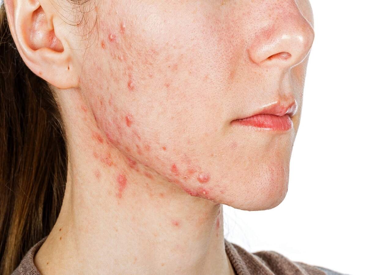 Skin Care Tips – Do you know why pimples appear? Let's find out.